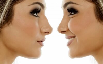 What Is The Cost Of A Rhinoplasty?