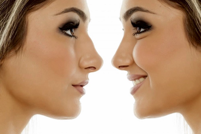 What Is The Cost Of A Rhinoplasty?